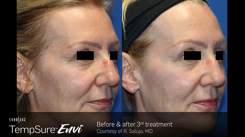 TempSure Envi Before & After | Skin Tightening TempSure Envi