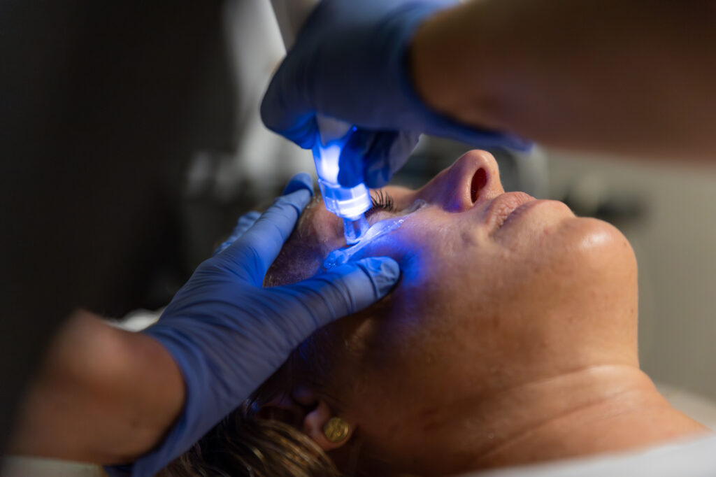 A provider at Chandler Eye Care is performing skin tightening near Short Pump on a patient's under-eyes. The provider, wearing surgical gloves, carefully guides the TempSure hand-held device over the treatment area to tighten the skin.